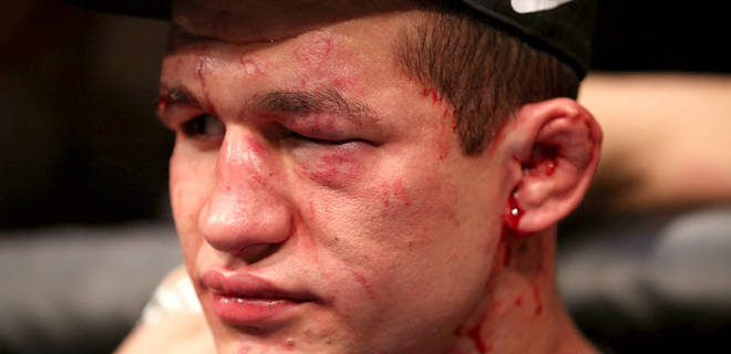 Junior Dos Santos Out For At Least 3 Months - Junior Dos Santos Out For At Least 3 Months -